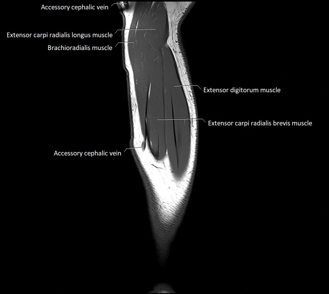 MRI 3T forearm sagittal labelled cross sectional anatomy image 8.webp